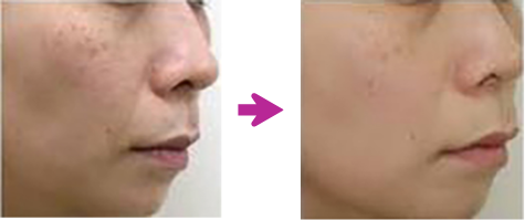 フォトフェイシャル